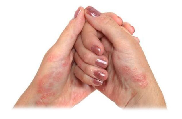 Skin affected by psoriasis